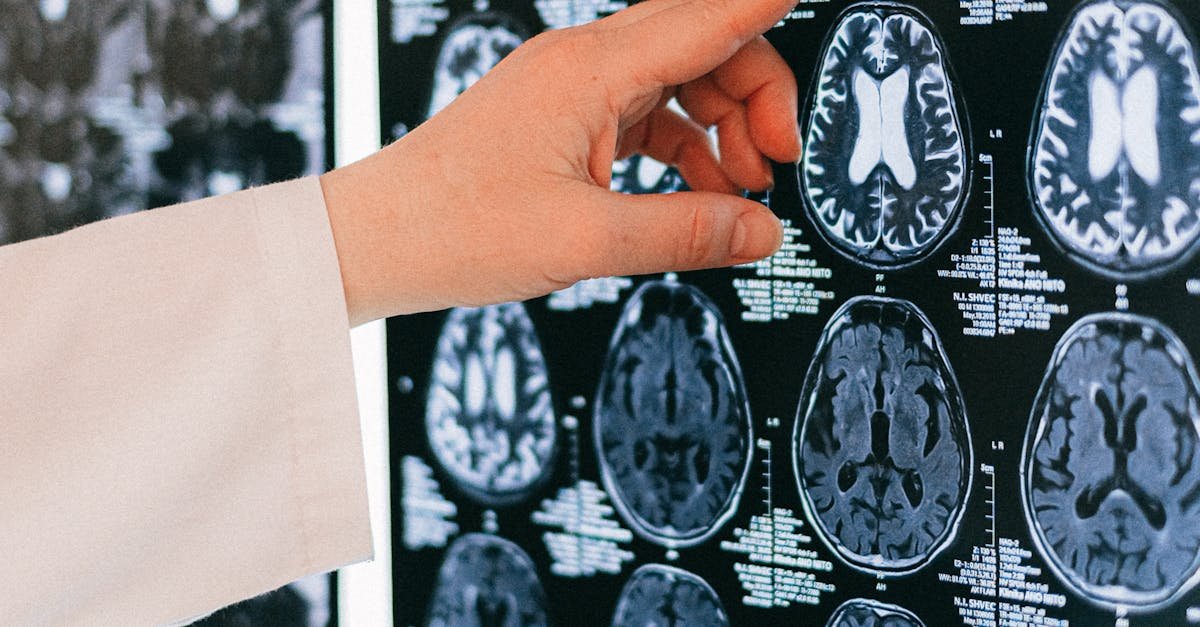A doctor's hand points to a brain MRI scan on a lightbox, illustrating medical diagnosis.