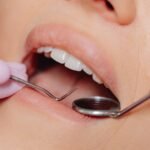 silver-diamine-fluoride-stop-childhood-cavities-without-drilling-trial